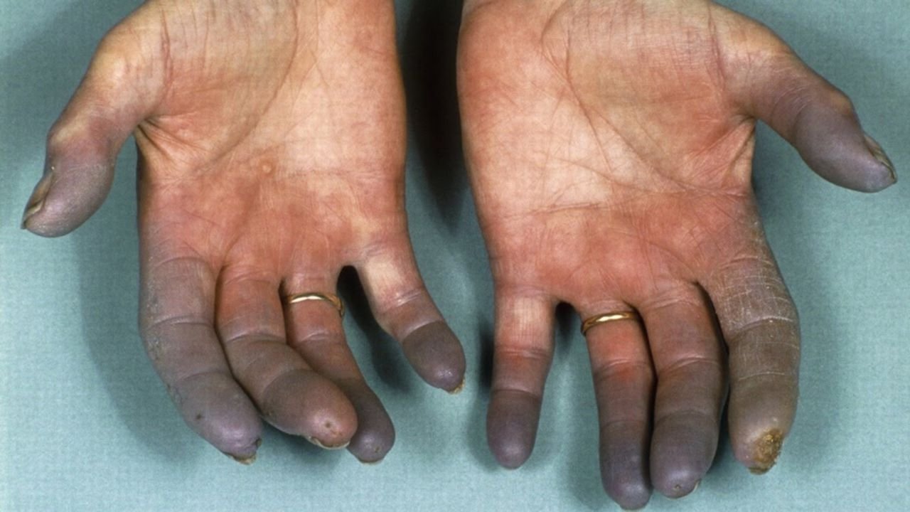 Buerger’s Disease: बीड़ी-सिगरेट से नसें हो जाती हैं बंद, धीरे-धीरे खत्म हो जाता है शरीर का हिस्सा
