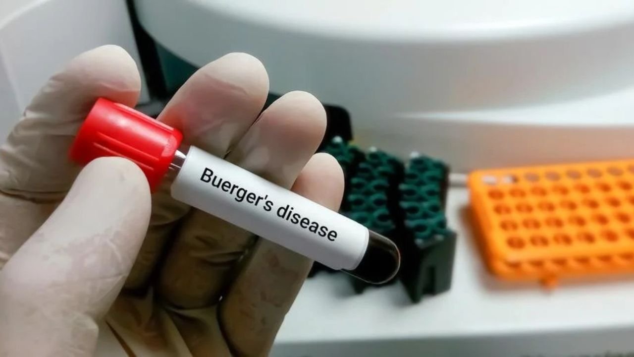 Buerger’s Disease: बीड़ी-सिगरेट से नसें हो जाती हैं बंद, धीरे-धीरे खत्म हो जाता है शरीर का हिस्सा